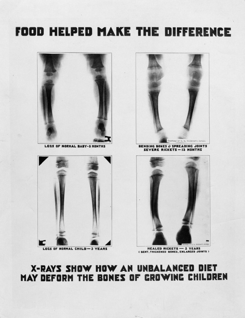 Aliments ont contribué à faire la différence. Les radiographies montrent comment une alimentation déséquilibrée peut déformer les os des enfants en pleine croissance